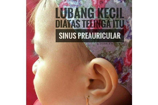 preauricular sinus